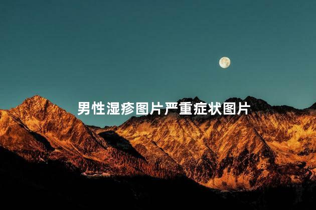 男性湿疹图片严重症状图片